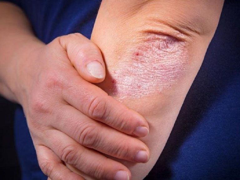 Bệnh vảy nến: Cách kiểm soát hiệu quả và hạn chế tái phát
