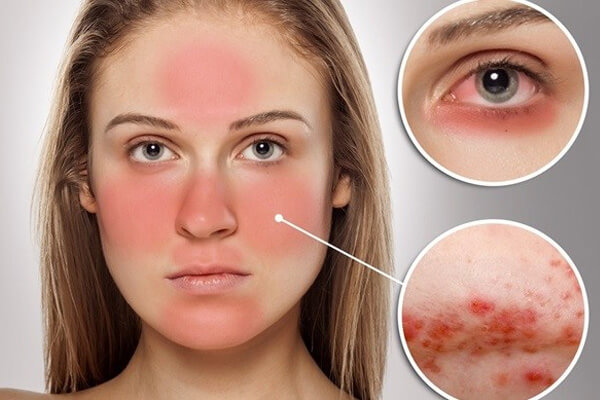 Lupus ban đỏ hệ thống: Nguyên nhân, triệu chứng và hướng điều trị