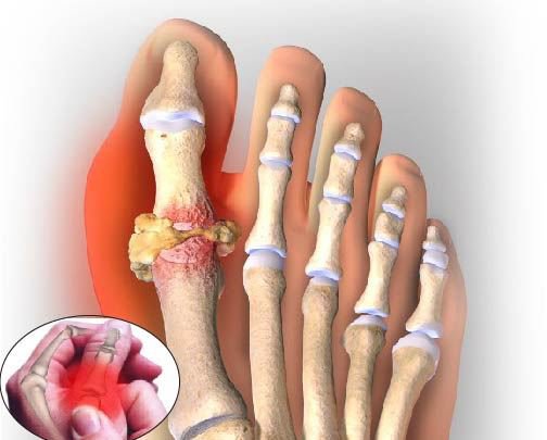 bệnh gout là gì