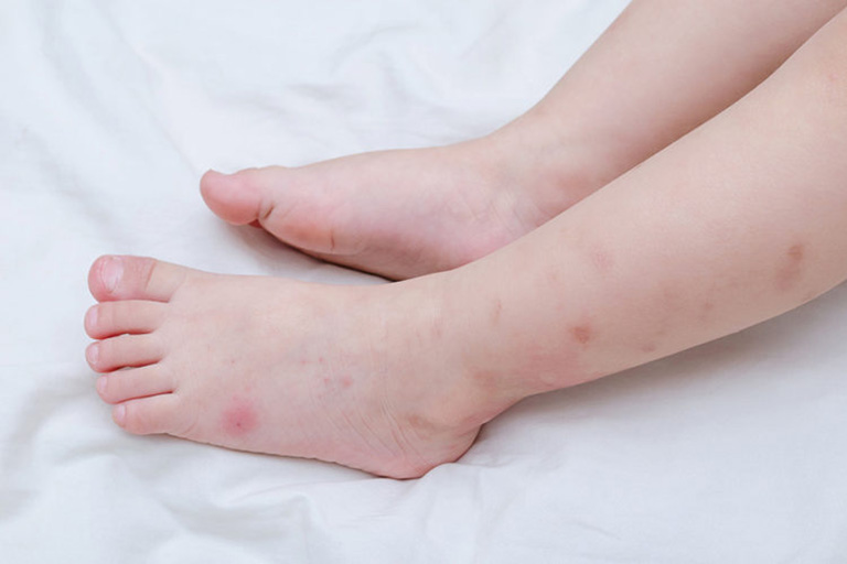 bé bị nổi mẩn