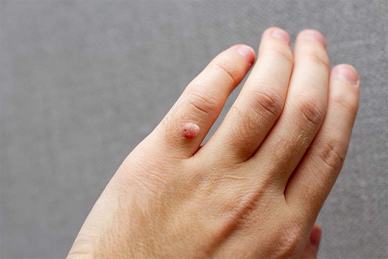 chữa mụn cóc tại nhà